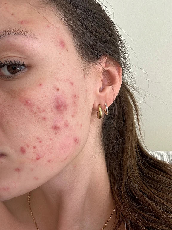 Skin before and after using Afina — before