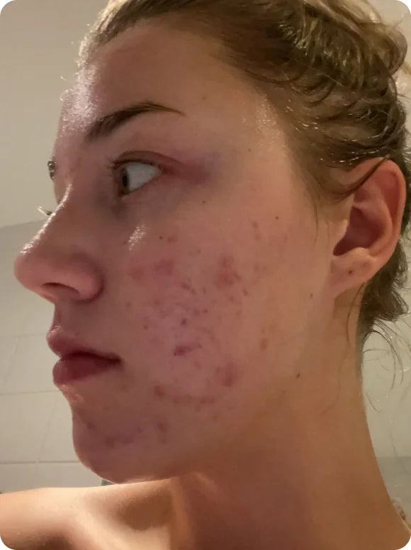 Skin before and after using Afina — before