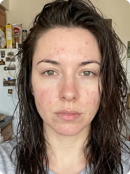 Skin before and after using Afina — before